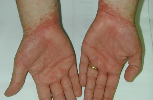 Dermatitis (IV): Dermatitis de Contacto Farmacia Jiménez