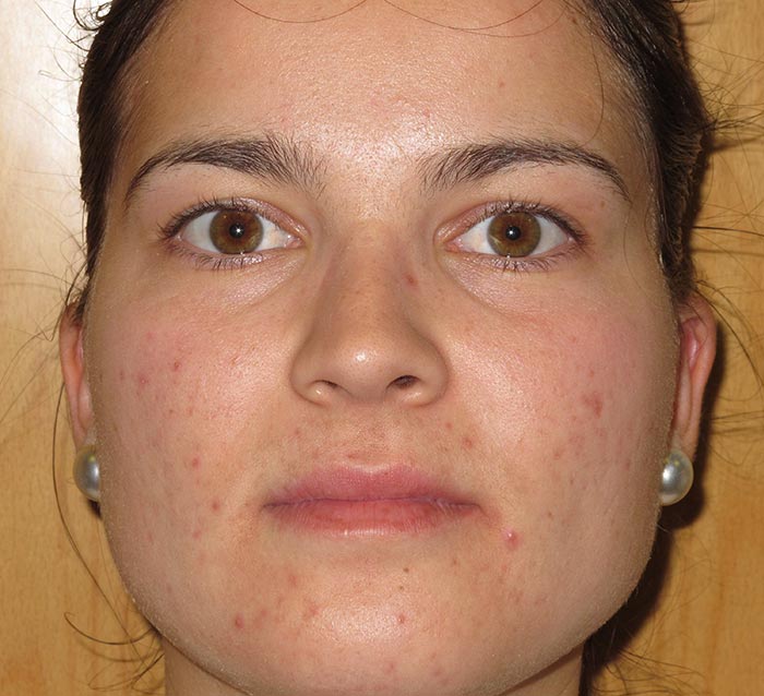 Eliminar acné y la piel grasa Farmacia Jiménez