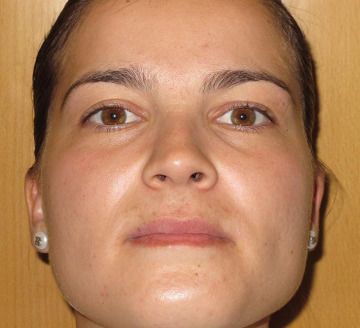 Eliminar el acné y la piel grasa
