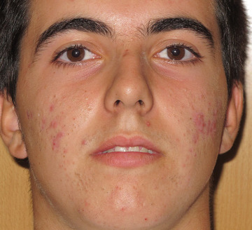 Eliminar acné juvenil, puntos negros y cicatrices residuales