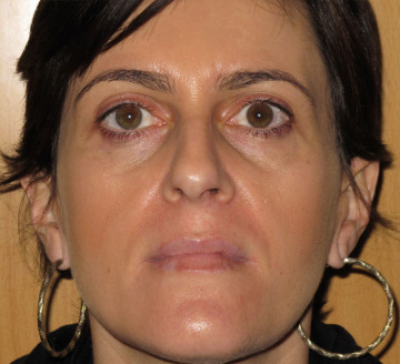 Tratamiento de manchas faciales y luminosidad