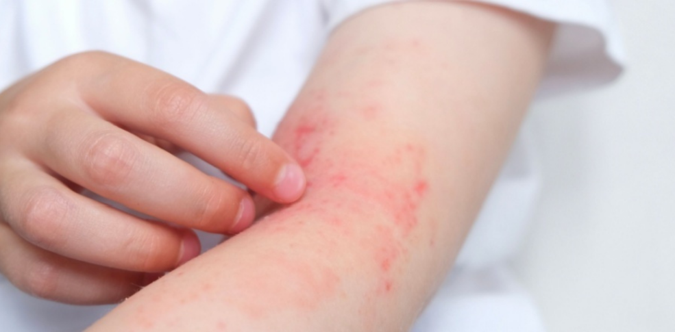 Diferencia entre dermatitis atópica y seborreica: cómo distinguirlas y elegir el cuidado adecuado
