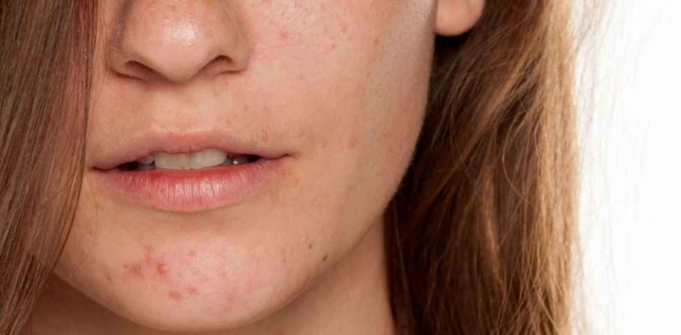 ¿Cuál es la mejor crema hidratante para piel grasa? Guía experta para hidratar sin engrasar