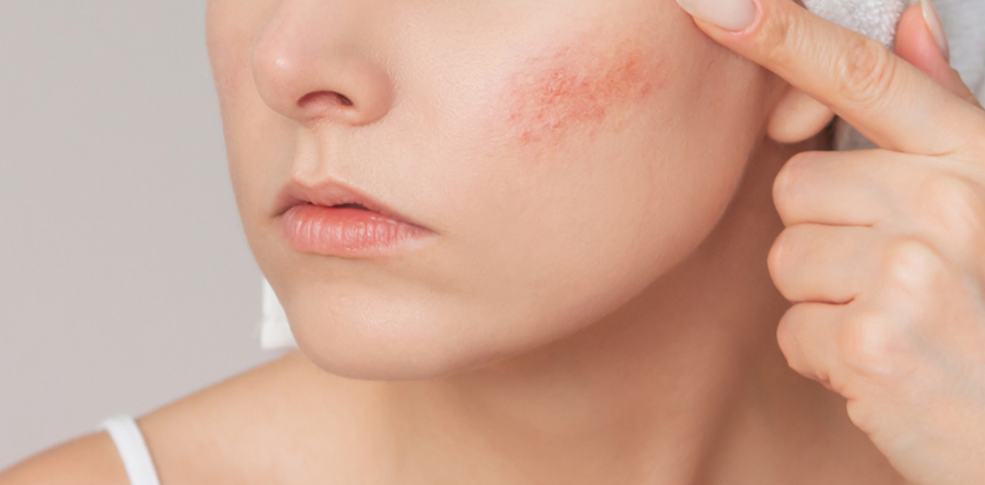 Las mejores cremas para la rosácea: alivio, protección y cuidado experto
