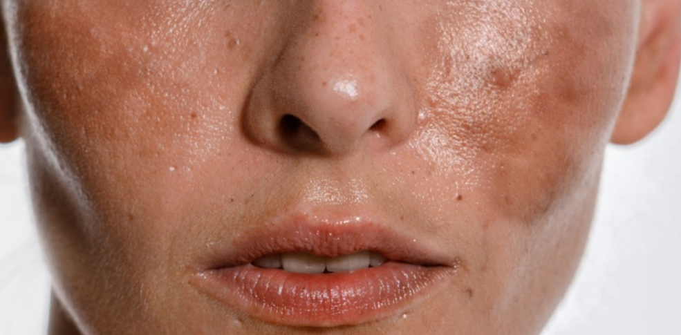 Retinol y manchas: cómo eliminar las manchas de la piel con retinoides