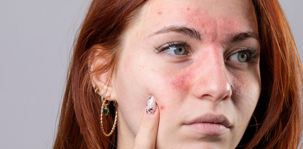 Retinol y rosácea: ¿se puede usar retinol si tienes rosácea?